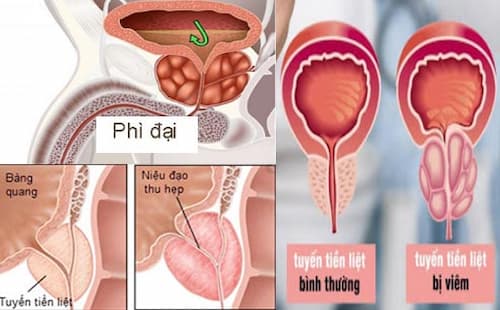 Bệnh về tuyến tiền liệt