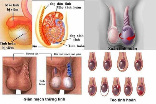 bệnh về tinh hoàn