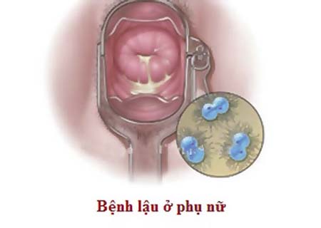 CÁCH ĐIỀU TRỊ BỆNH LẬU Ở NỮ GIỚI ĐEM LẠI HIỆU QUẢ