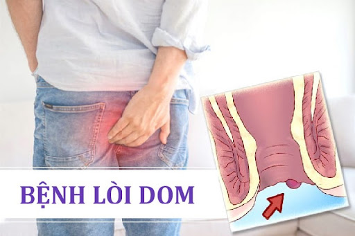 Tìm hiểu bệnh lòi dom ở phụ nữ có nguy hiểm không?