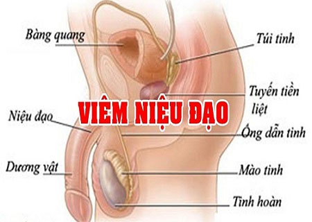 Viêm niệu đạo ở nam giới