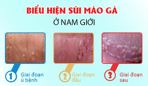 MỤN CÓC SINH DỤC LÀ GÌ?