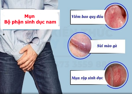 Các loại mụn ở bộ phận sinh dục nam