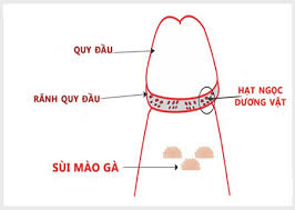 Hạt ngọc dương vật là gì và cách chữa