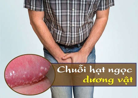 Tìm hiểu chuỗi hạt ngọc dương vật