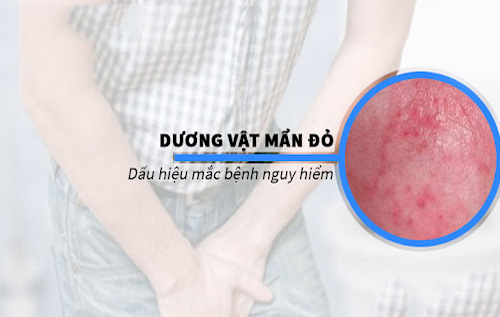 Dương vật nổi mẩn đỏ là bị làm sao?