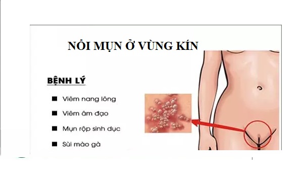 Nổi mụn vùng kín là bệnh gì?