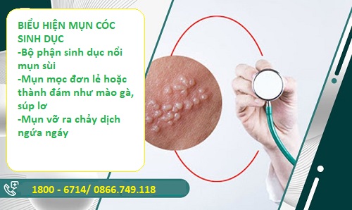 BỆNH MỤN CÓC SINH DỤC CÓ THỂ TỰ KH.ỎI ĐƯỢC KHÔNG?