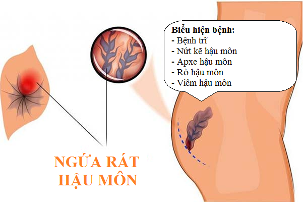 CÁCH CHỮA NGỨA RÁT HẬU MÔN