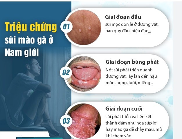 MÁCH NHỎ BẠN: CÁCH CHỮA BỆNH SÙI MÀO GÀ HIỆU QUẢ?