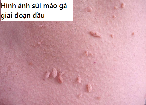 HÌNH ẢNH GIAI ĐOẠN ĐẦU SÙI MÀO GÀ