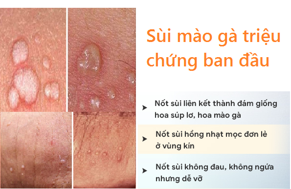 NHẬN BIẾT: SÙI MÀO GÀ TRIỆU CHỨNG BAN ĐẦU