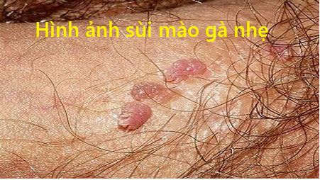 HÌNH SÙI MÀO GÀ NHẸ