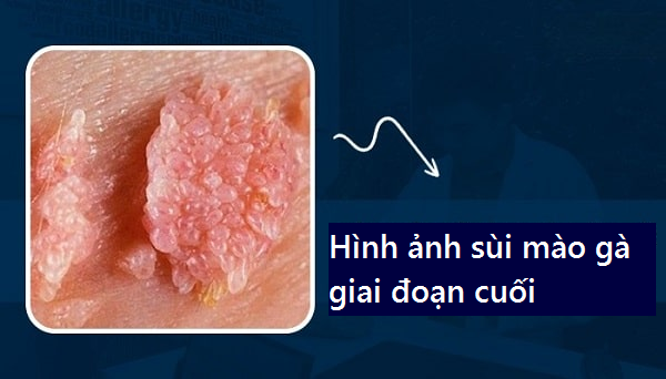 HÌNH ẢNH BỆNH SÙI MÀO GÀ GIAI ĐOẠN CUỐI