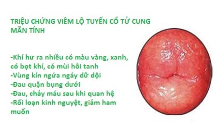 VIÊM LỘ TUYẾN CỔ TỬ CUNG MÃN TÍNH LÀ GÌ?