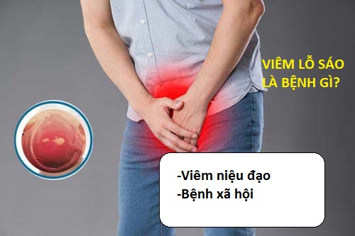 VIÊM LỖ SÁO LÀ GÌ? NGUYÊN NHÂN, BIỂU HIỆN VÀ CÁCH ĐIỀU TRỊ