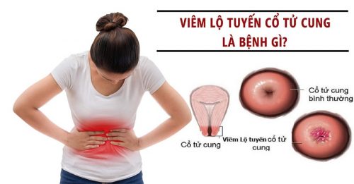 Viêm lộ tuyến cổ tử cung: Nguyên nhân, triệu chứng, phương pháp điều trị