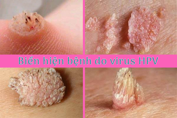 Dấu hiệu khi bị nhiễm hpv