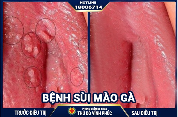 Hành trình “vĩnh biệt” sùi mào gà hồi hộp đến thót tim