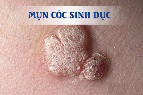 Nguyên nhân mụn cóc sinh dục