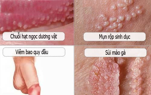 NỔI HẠT TRẮNG Ở ĐẦU KHẤC