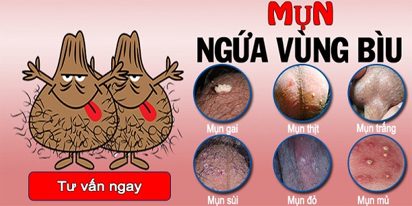 BÌU BỊ NGỨA VÀ NỔI MỤN – NGUYÊN NHÂN LÀ DO ĐÂU?